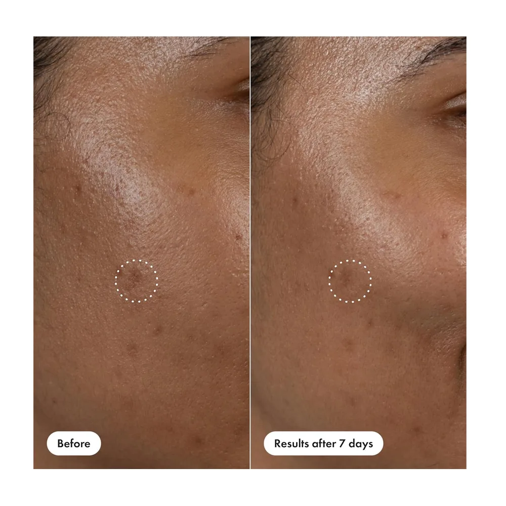 Front angle of hero cosmetics dark spot correct spot-fading serum, vitamin c, hyaluronic acid, for acne-prone skin, 10ml
